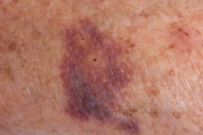 An image of a large bruise on elderly skin