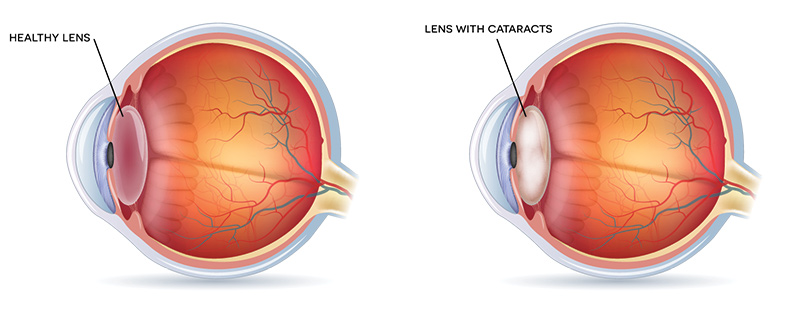 cataract illustration eye older adult