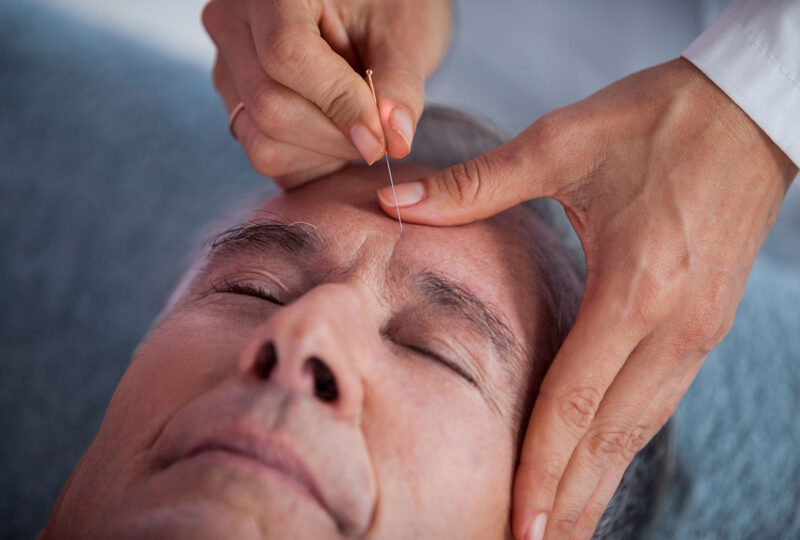 man getting acupuncture in forehead