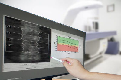Close-up hand Doctor point Image of DXA bone density scan on a monitor