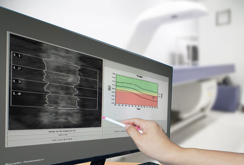 Close-up hand Doctor point Image of DXA bone density scan on a monitor