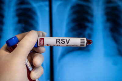 Blood collection tubes Respiratory syncytial virus(RSV) test positive results,medical concept