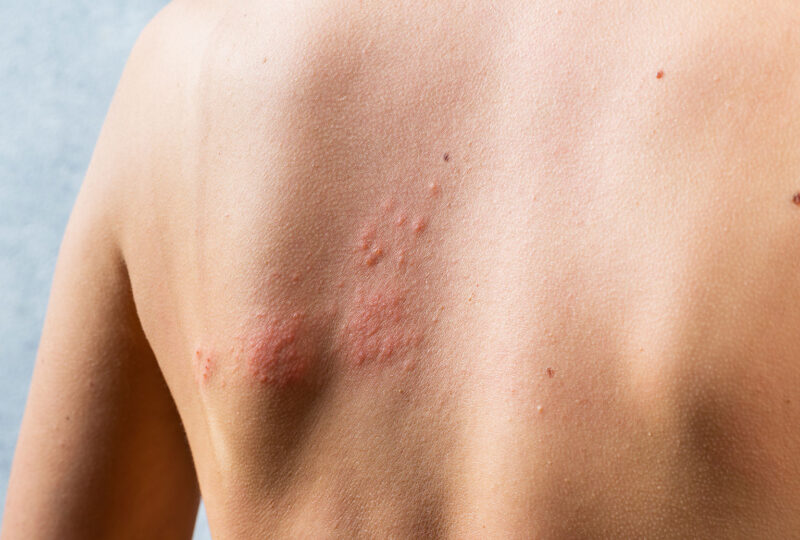 Shingles, varicella-zoster virus. skin rash and blisters on body.